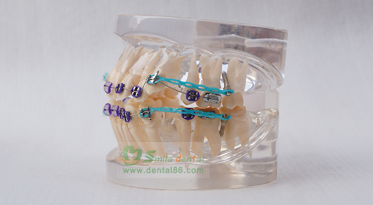 TM-B2-02 Orthodontic Model